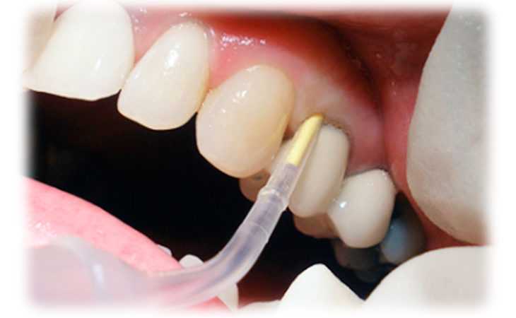 Реставрація зубів: чому бічні зуби потрібно реставрувати?