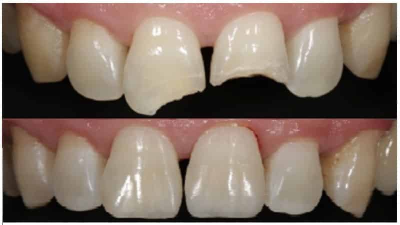 Методи нарощування зубів