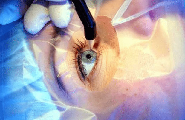 После COVID-19 популярны процедуры лазерной коррекции зрения