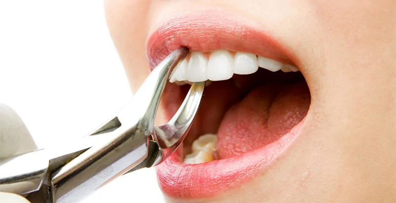 Лечить или удалять больные зубы: что лучше