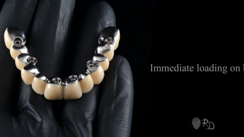 Що вам потрібно знати про зубні імплантати
