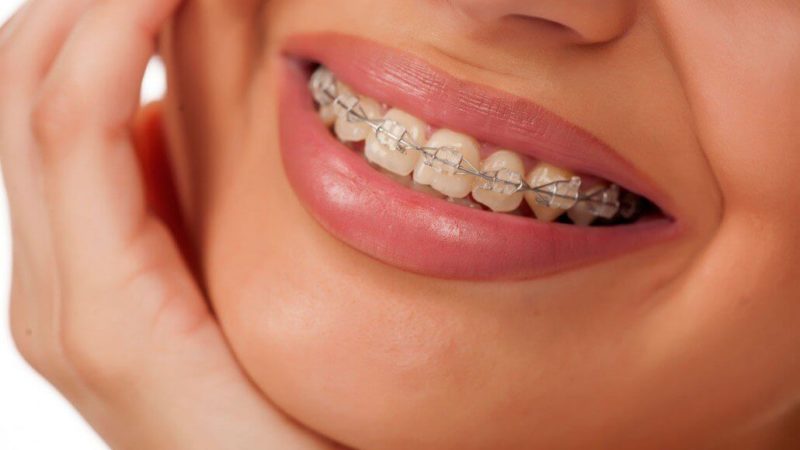 Процес встановлення зубних брекетів: як це відбувається?