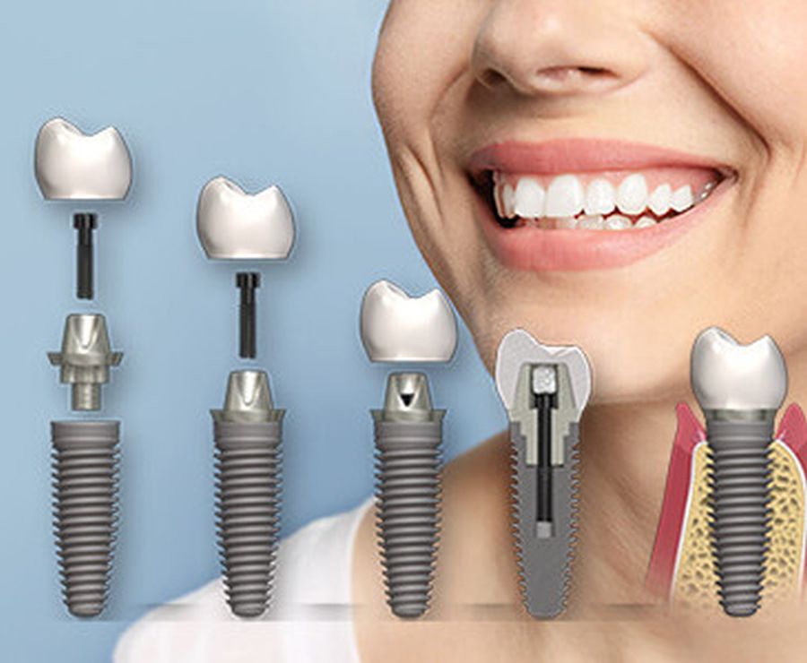 Які види імплантації зубів існують?