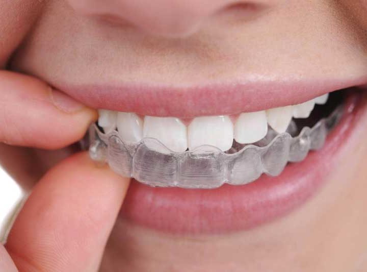 Відбілювання та вирівнювання зубів