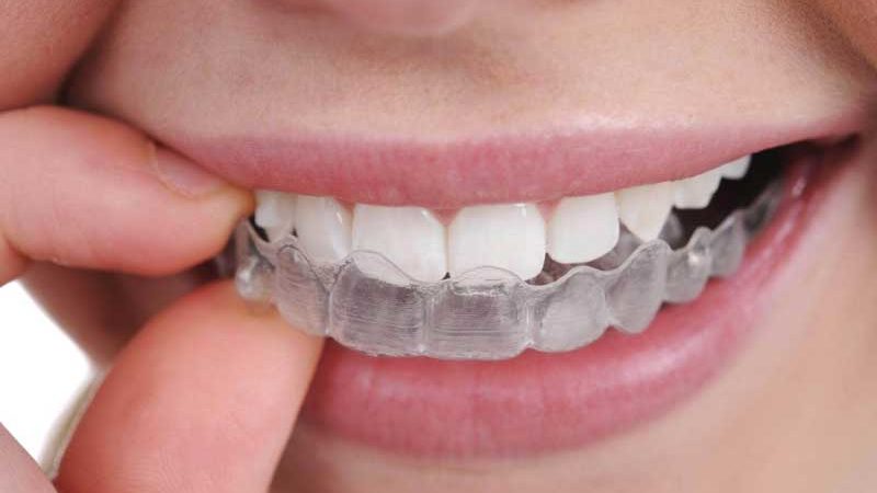 Відбілювання та вирівнювання зубів