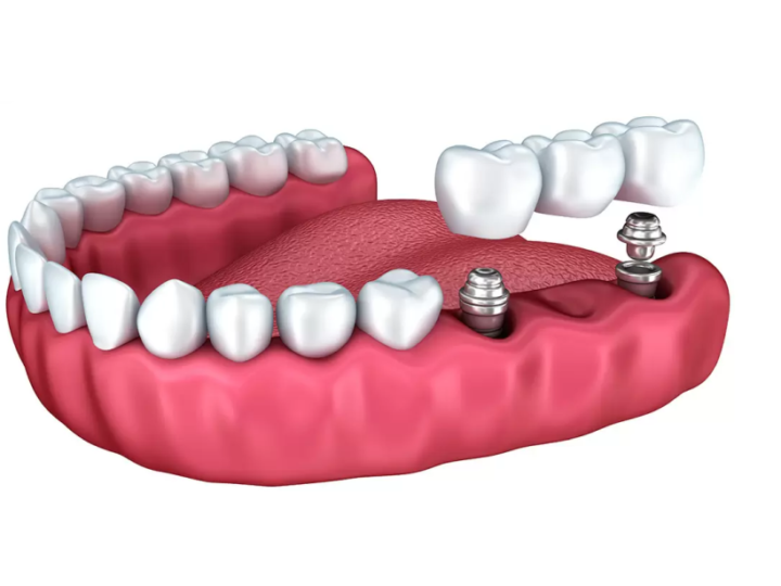Як швидко можна отримати функціонуючий зуб при імплантації?